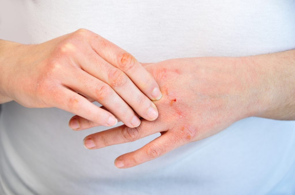 Atopic Dermatitis (Eczema): Causes, Symptoms, Treatments and Medications