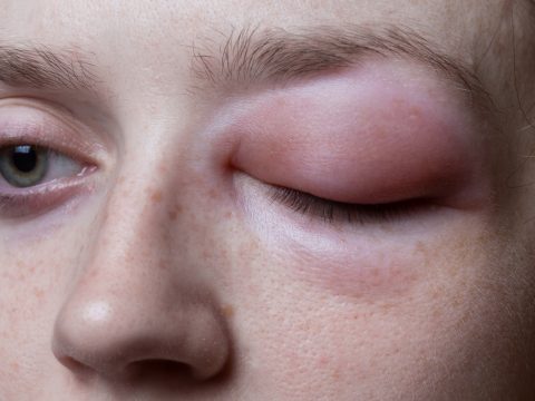 Angioedema allergic swelling