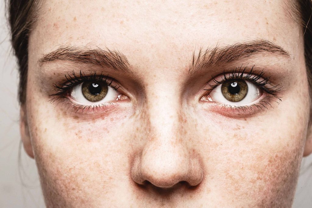 Eye Allergy Types, Symptoms, Causes, Home Remedies and Treatment