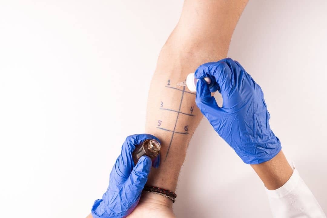 An allergy specialist in Texas runs tests to determine if the patient is suited for sublingual immunotherapy.